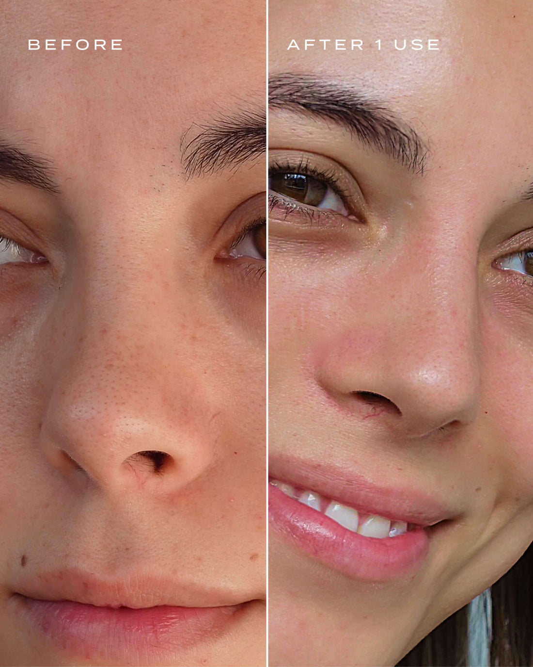 Vue -Patchs pour le Nez