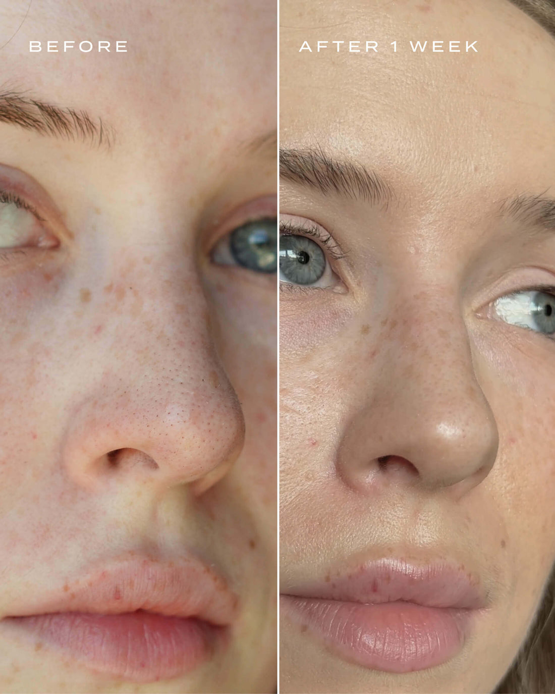 Vue -Patchs pour le Nez