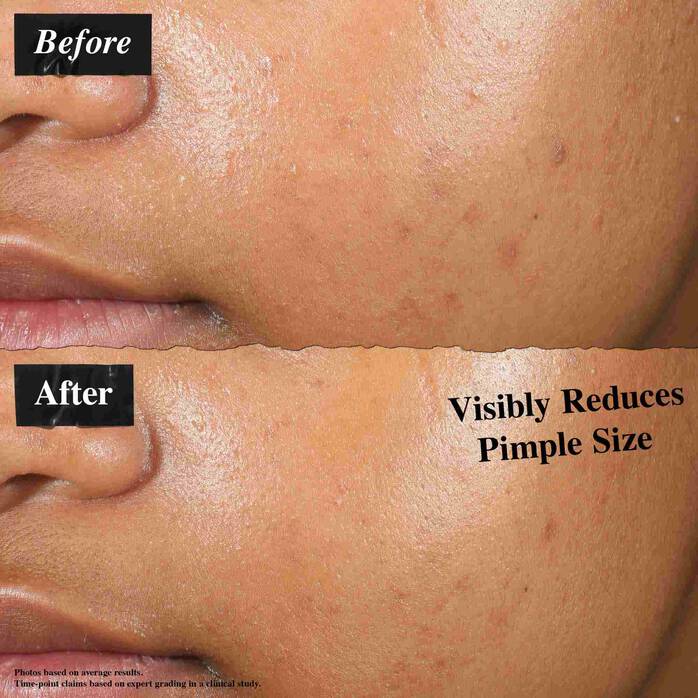 Patch Liquide Invisible Anti-Imperfections